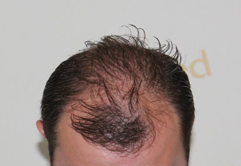Deamed - hair transplantation results / თმის გადანერგვის შედეგები