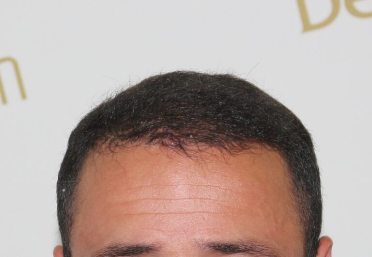 Deamed - hair transplantation results / თმის გადანერგვის შედეგები