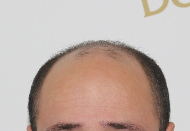 Deamed - hair transplantation results / თმის გადანერგვის შედეგები