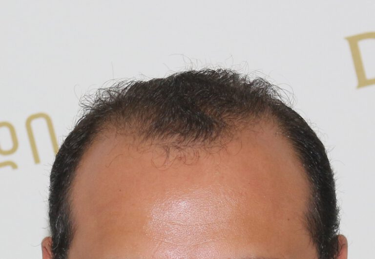 Deamed - hair transplantation results / თმის გადანერგვის შედეგები