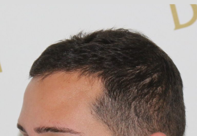 Deamed - hair transplantation results / თმის გადანერგვის შედეგები