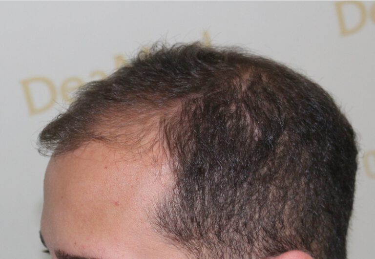 Deamed - hair transplantation results / თმის გადანერგვის შედეგები