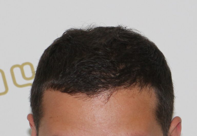 Deamed - hair transplantation results / თმის გადანერგვის შედეგები