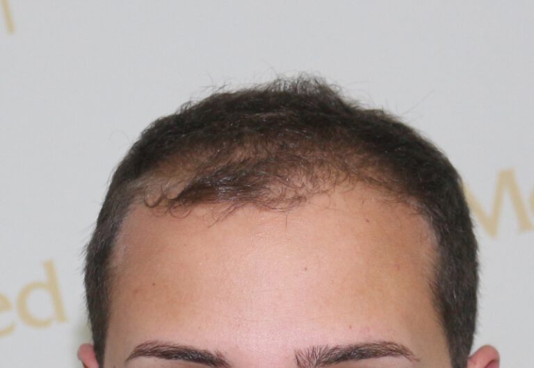 Deamed - hair transplantation results / თმის გადანერგვის შედეგები