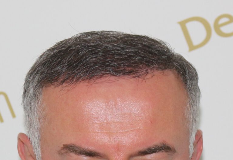 Deamed - hair transplantation results / თმის გადანერგვის შედეგები