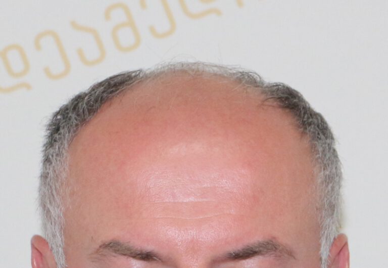 Deamed - hair transplantation results / თმის გადანერგვის შედეგები