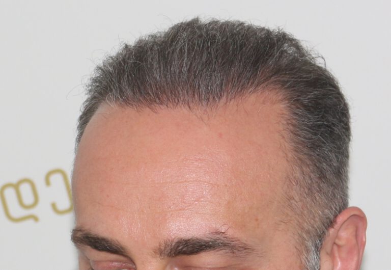 Deamed - hair transplantation results / თმის გადანერგვის შედეგები