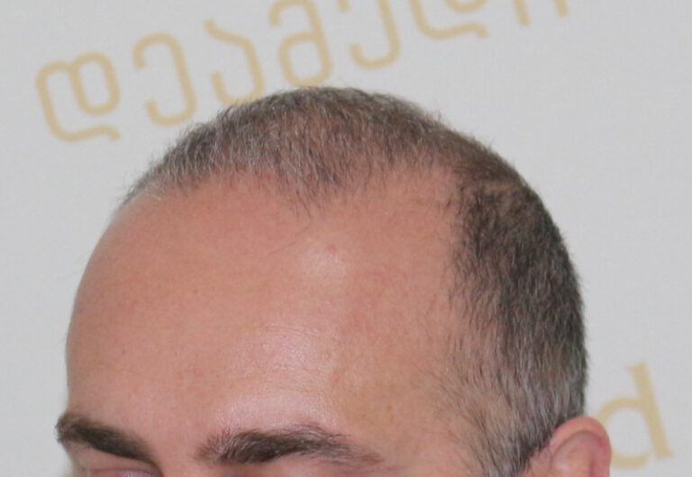 Deamed - hair transplantation results / თმის გადანერგვის შედეგები