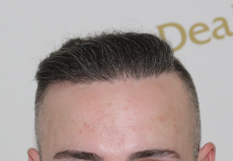 Deamed - hair transplantation results / თმის გადანერგვის შედეგები