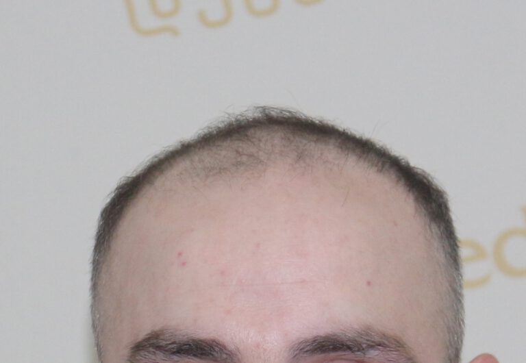 Deamed - hair transplantation results / თმის გადანერგვის შედეგები