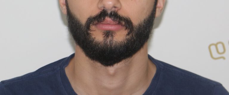 Deamed - hair transplantation results / თმის გადანერგვის შედეგები