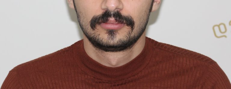 Deamed - hair transplantation results / თმის გადანერგვის შედეგები