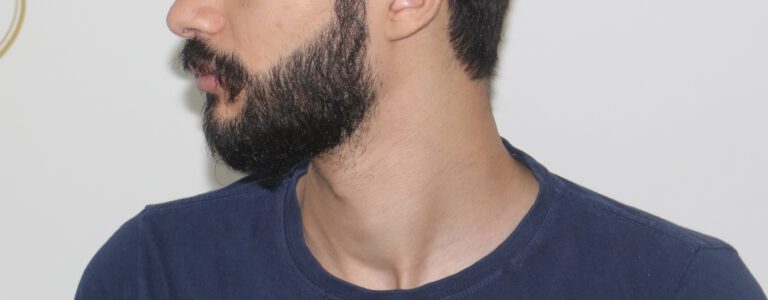 Deamed - hair transplantation results / თმის გადანერგვის შედეგები