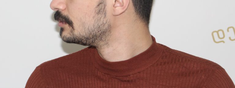 Deamed - hair transplantation results / თმის გადანერგვის შედეგები