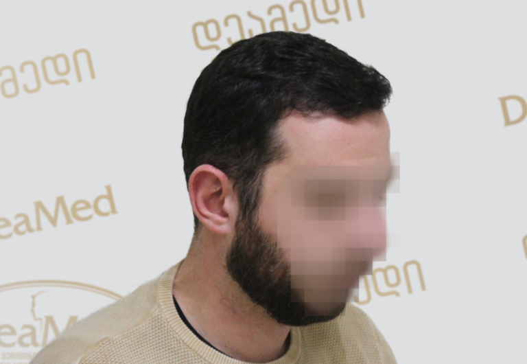 Deamed - hair transplantation results / თმის გადანერგვის შედეგები