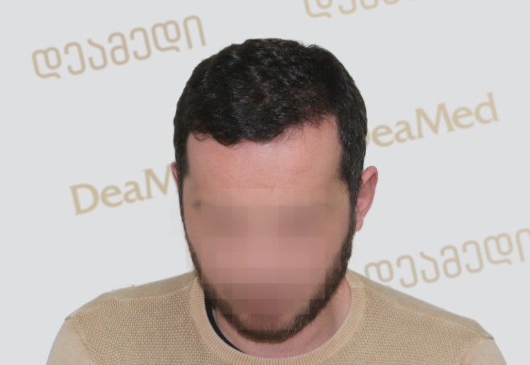 Deamed - hair transplantation results / თმის გადანერგვის შედეგები