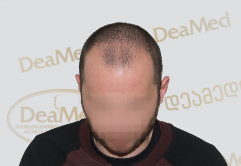 Deamed - hair transplantation results / თმის გადანერგვის შედეგები