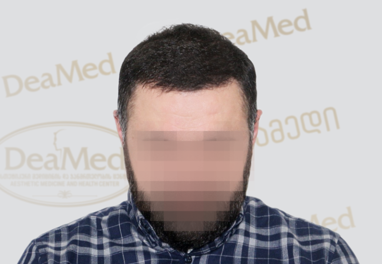 Deamed - hair transplantation results / თმის გადანერგვის შედეგები