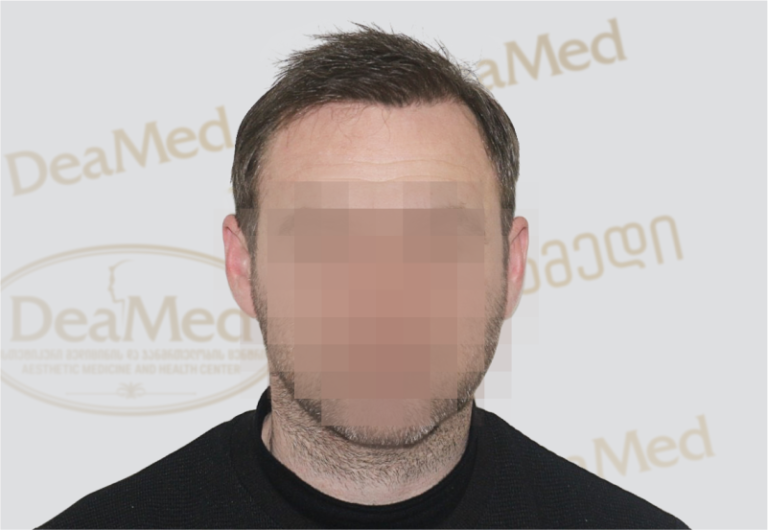 Deamed - hair transplantation results / თმის გადანერგვის შედეგები