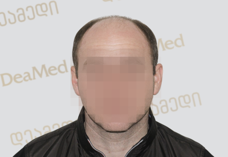 Deamed - hair transplantation results / თმის გადანერგვის შედეგები