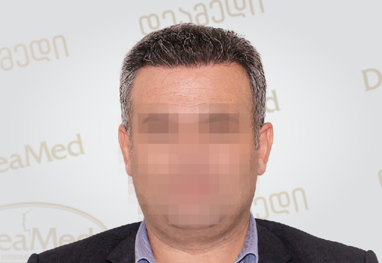 deamed-hair-transplantation