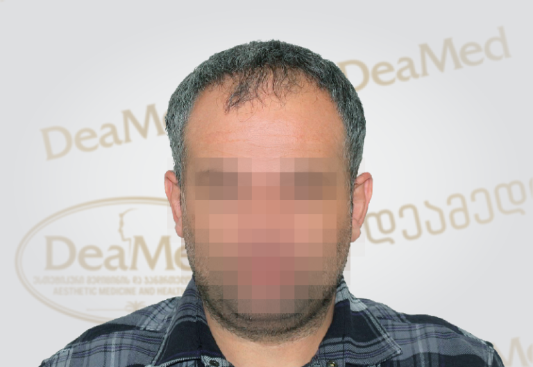 deamed-hair-transplantation
