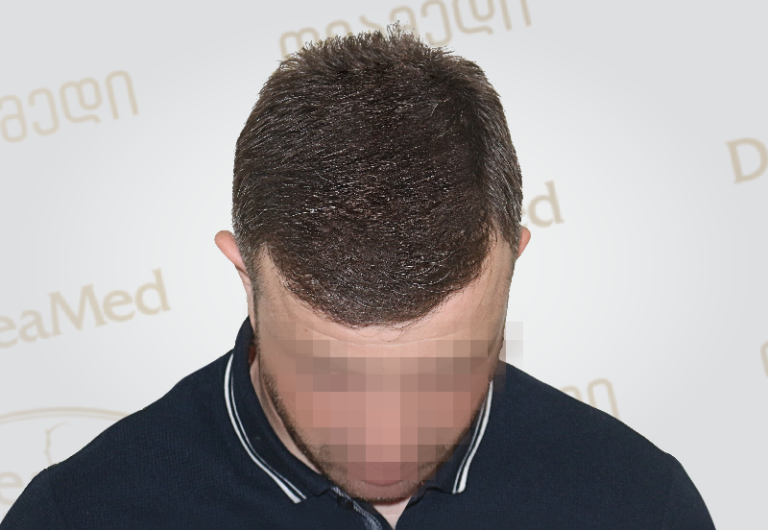 deamed-hair-transplantation