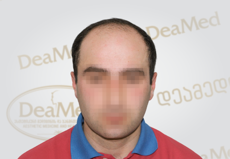 deamed-hair-transplantation
