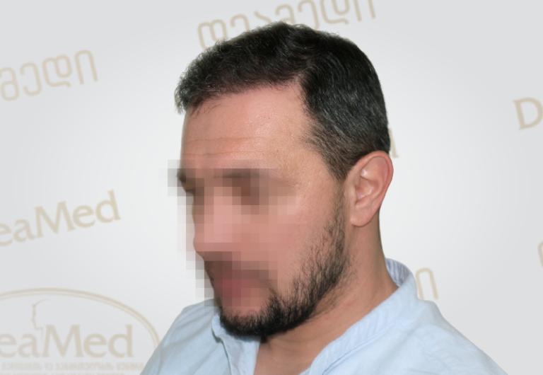 deamed-hair-transplantation