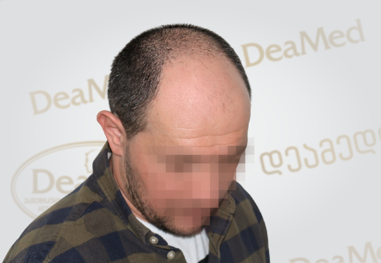 deamed-hair-transplantation