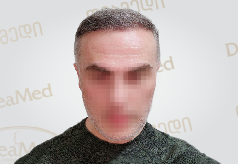 deamed-hair-transplantation