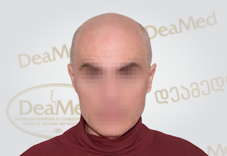 deamed-hair-transplantation