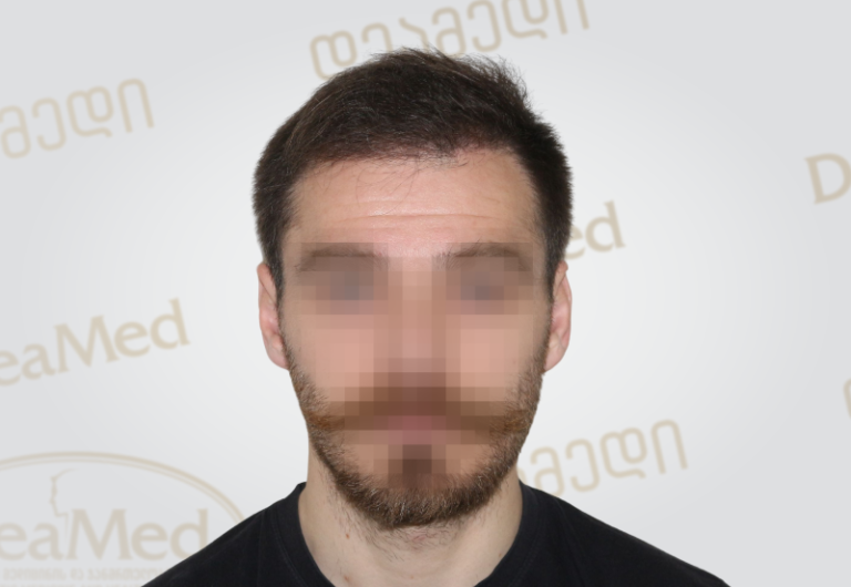 Deamed tmis gadanergvis shedegebi