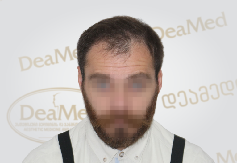 Deamed tmis gadanergvis shedegebi