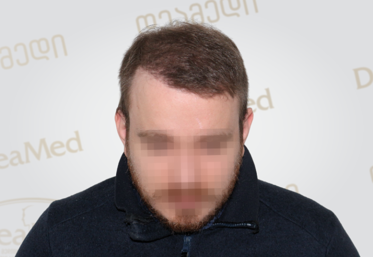 Deamed tmis gadanergvis shedegebi