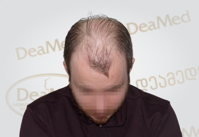 Deamed tmis gadanergvis shedegebi