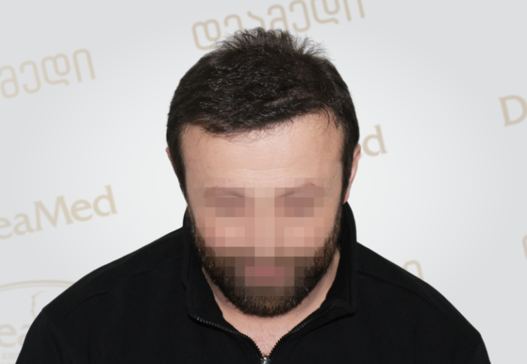 Deamed tmis gadanergvis shedegebi