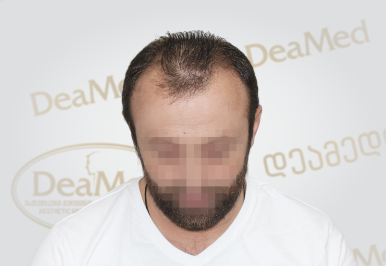 Deamed tmis gadanergvis shedegebi