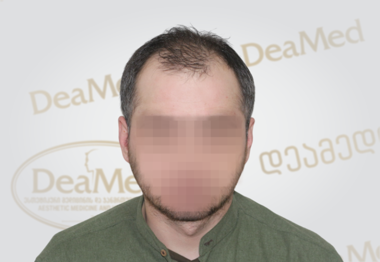 Deamed tmis gadanergvis shedegebi