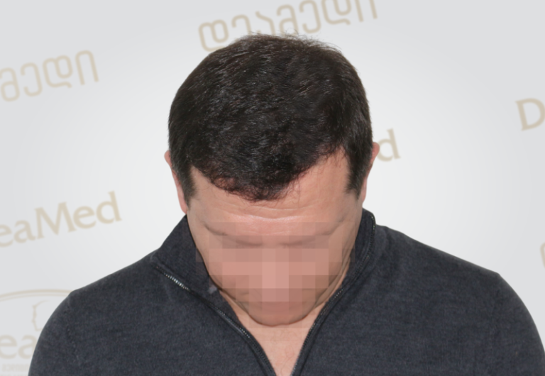 Deamed tmis gadanergvis shedegebi