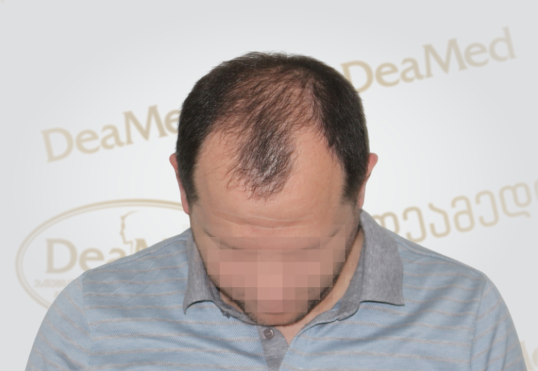 Deamed tmis gadanergvis shedegebi