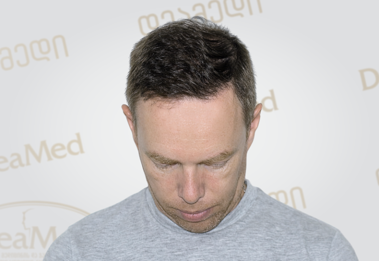 Deamed tmis gadanergvis shedegebi