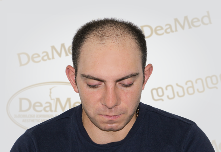 Deamed tmis gadanergvis shedegebi