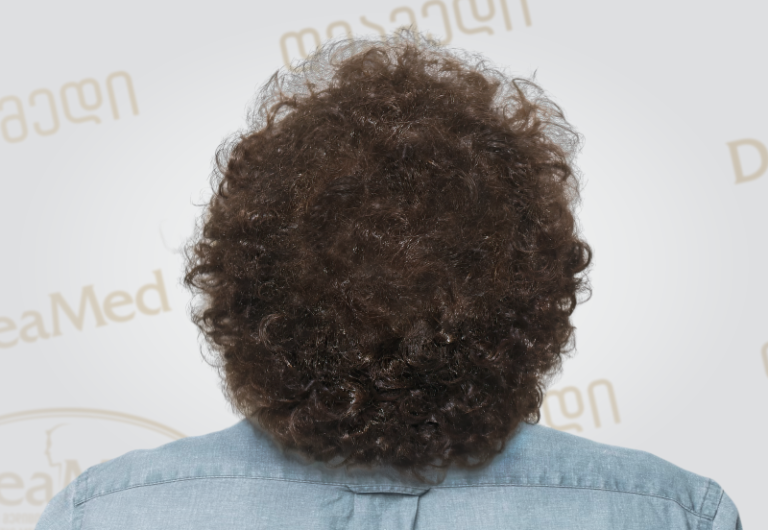 Deamed tmis gadanergvis shedegebi