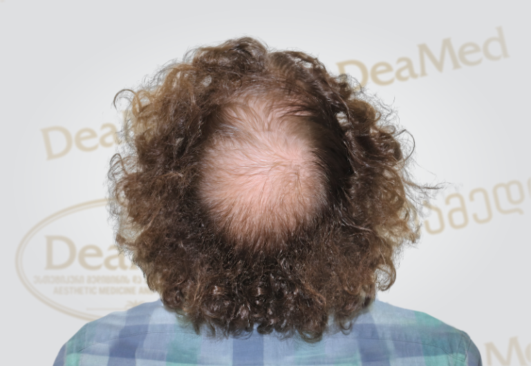 Deamed tmis gadanergvis shedegebi