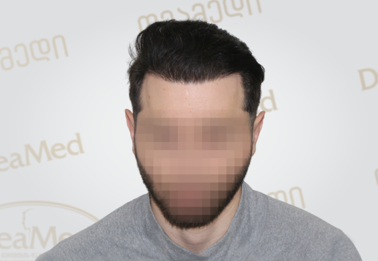 Deamed tmis gadanergvis shedegebi