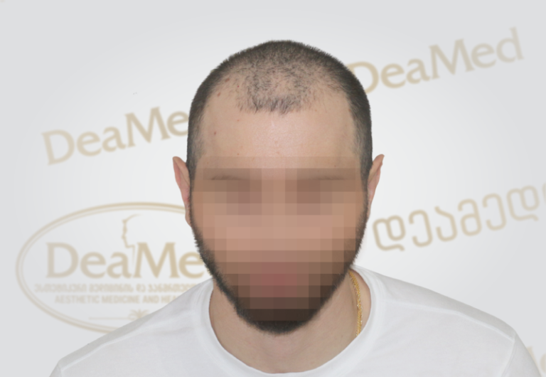 Deamed tmis gadanergvis shedegebi