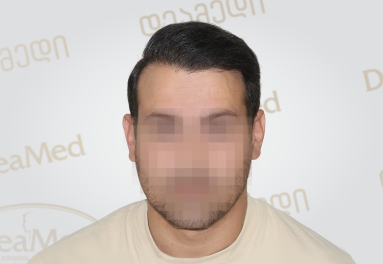 Deamed tmis gadanergvis shedegebi