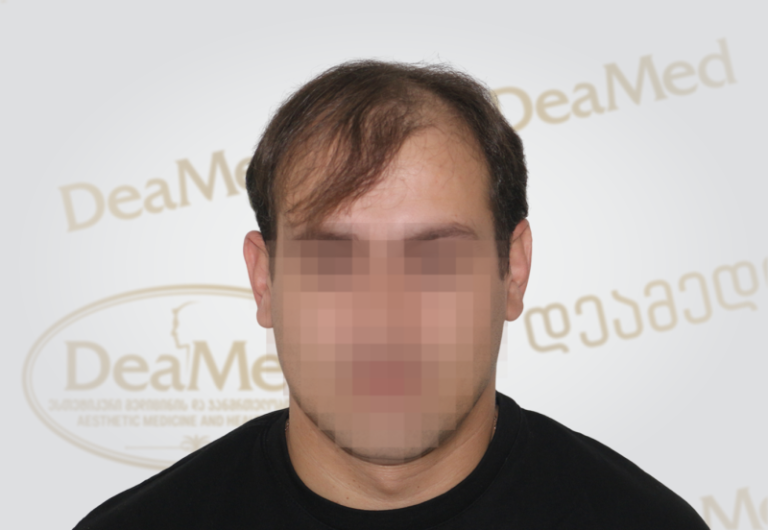 Deamed tmis gadanergvis shedegebi