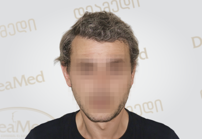 Deamed tmis gadanergvis shedegebi